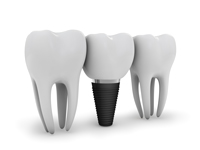 Dental Implants